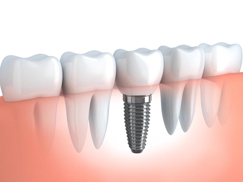 Dental Implants  Lexington, KY 
